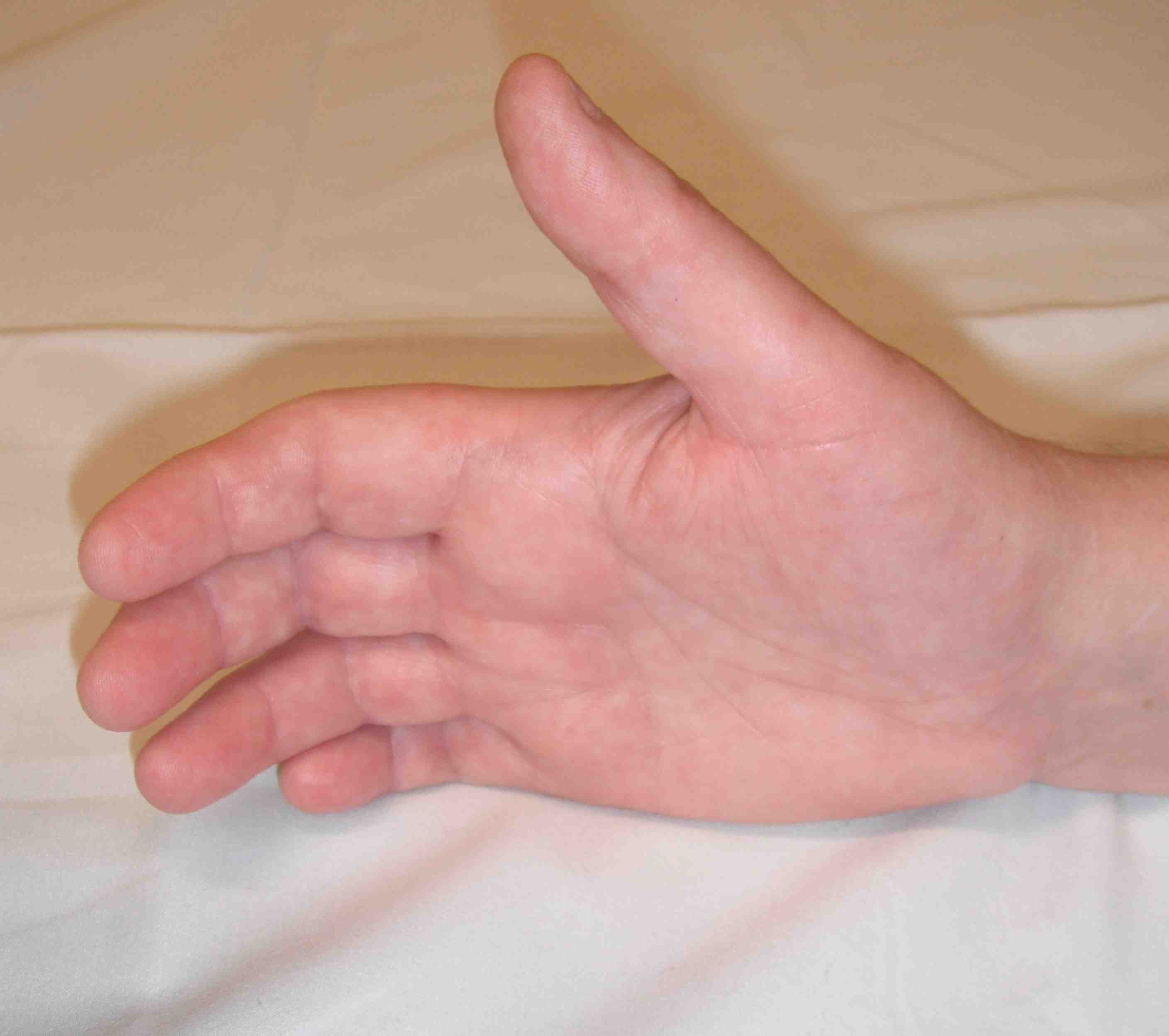 CRPS Hand